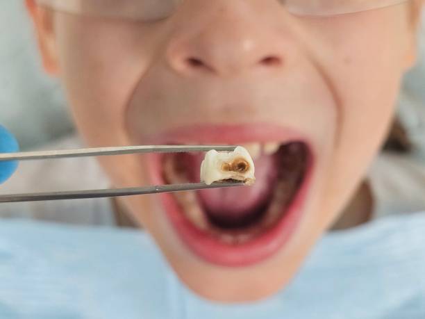 Best Emergency Dental Care for Broken or Chipped Teeth in Tukwila, WA